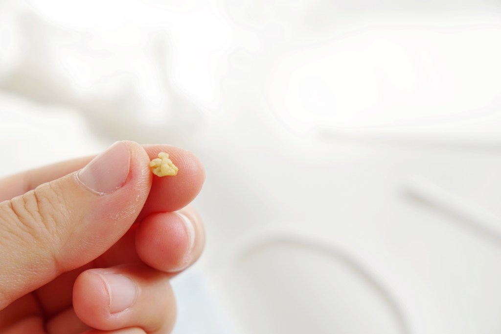 Extracted tonsil stone