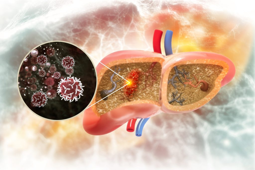 Liver cancer illustration