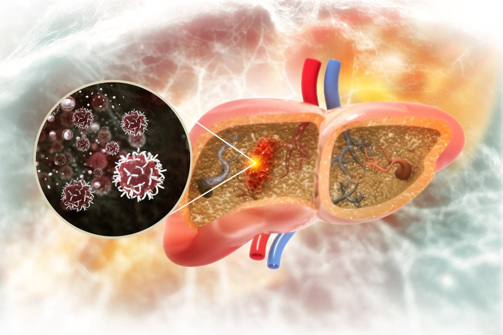 Liver cancer illustration