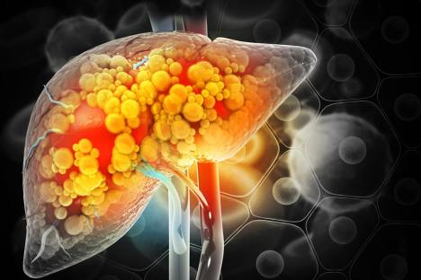 Keto and Fatty Liver: How to Reduce Liver Fat Fast