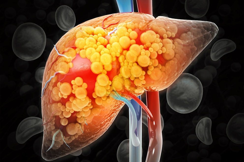 DRINK 1 CUP PER DAY to Remove Fat from Your Liver – Dr. Berg