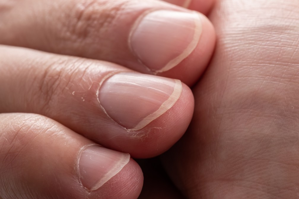 7 Common Signs of Vitamin Deficiencies in Nails