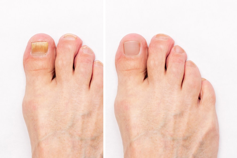 How to Get Rid of Toenail Fungus - 3 Natural Solutions