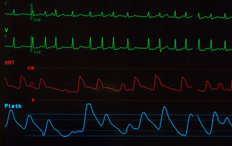 ECG showing atrial fibrillation