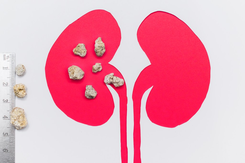 Kidney stone illustration