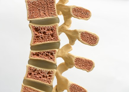 Osteoporosis and Osteopenia: How to Support Strong Bones