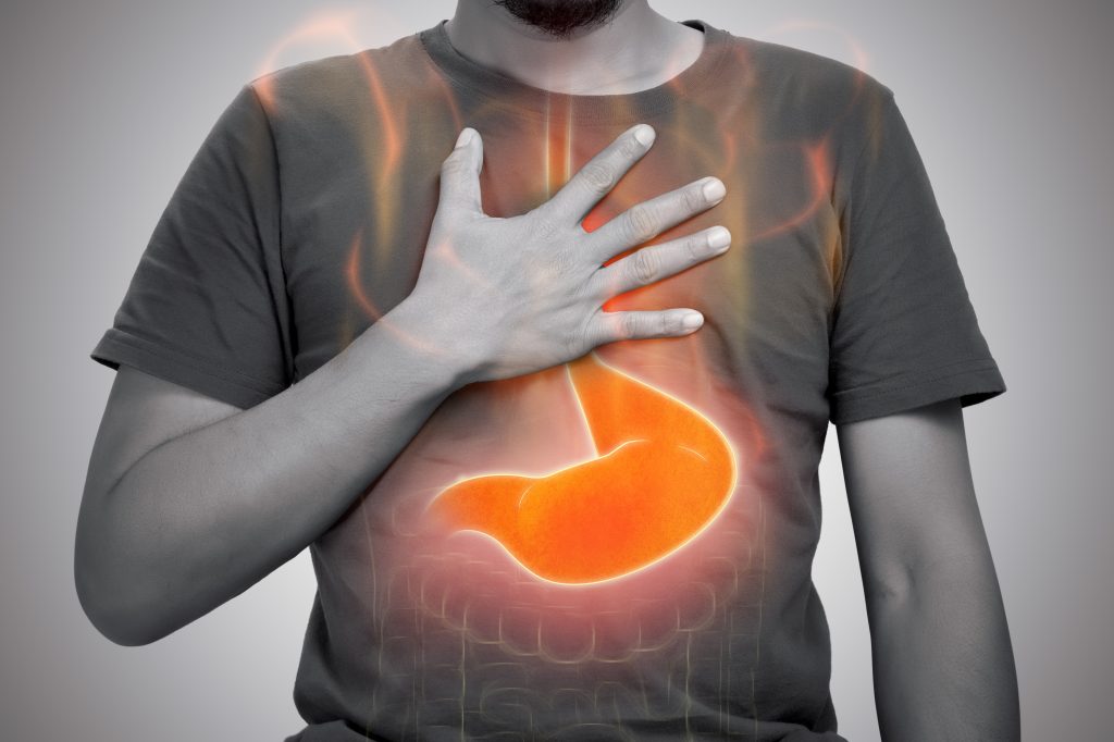 Acid reflux illustration 