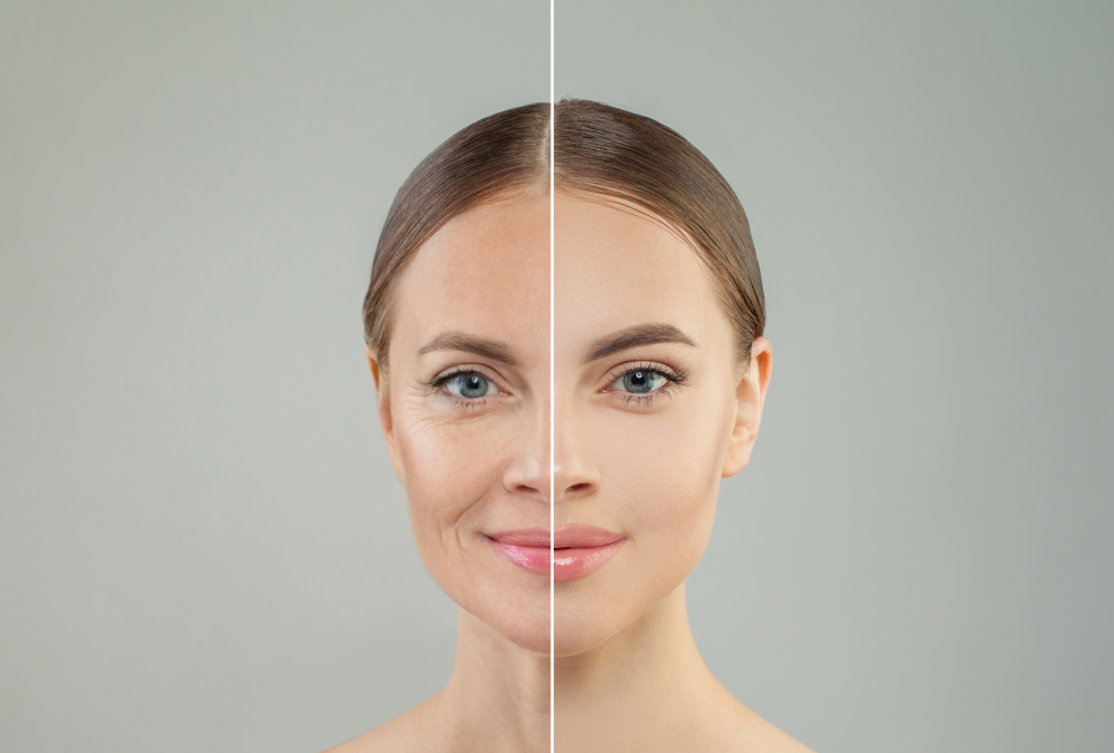 Woman before and after wrinkles