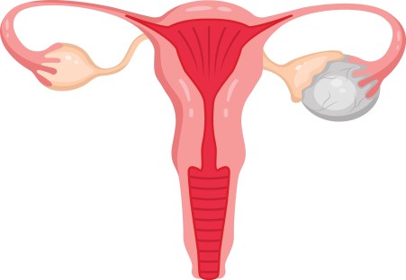 Iodine Deficiency and Ovarian Cysts: Is There a Connection?