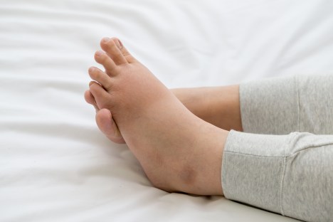 What Is Edema? Symptoms, Causes, and Natural Solutions