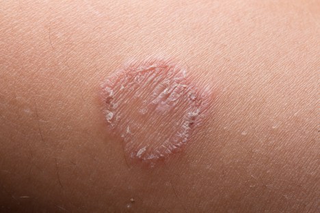 5 Natural Remedies for Ringworm and Prevention Tips