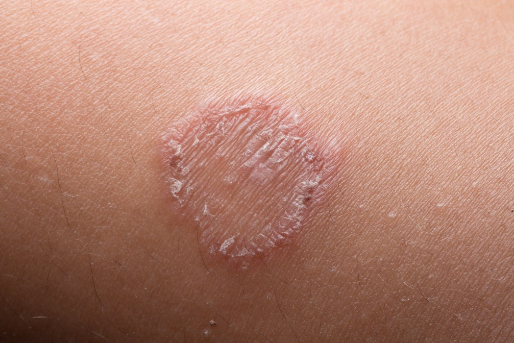 5 Natural Remedies for Ringworm and Prevention Tips