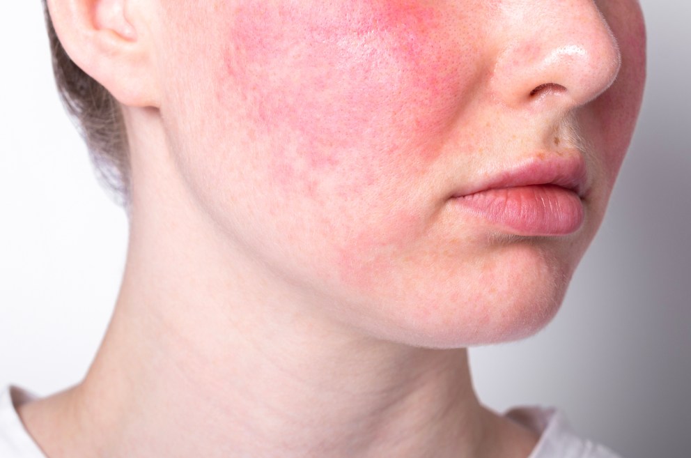 What Is the Top Cause of Rosacea?