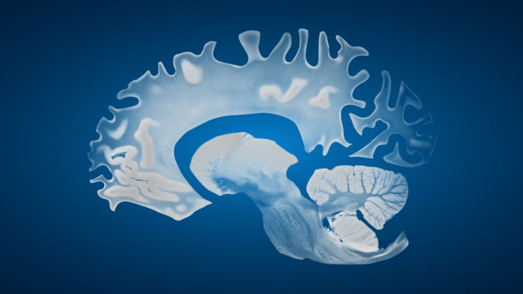 Alzheimer’s brain example