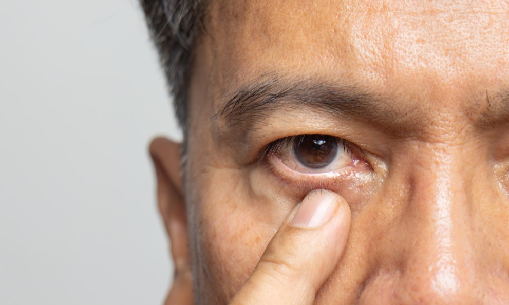 4 Ways to Lower Your Risk of Cataracts