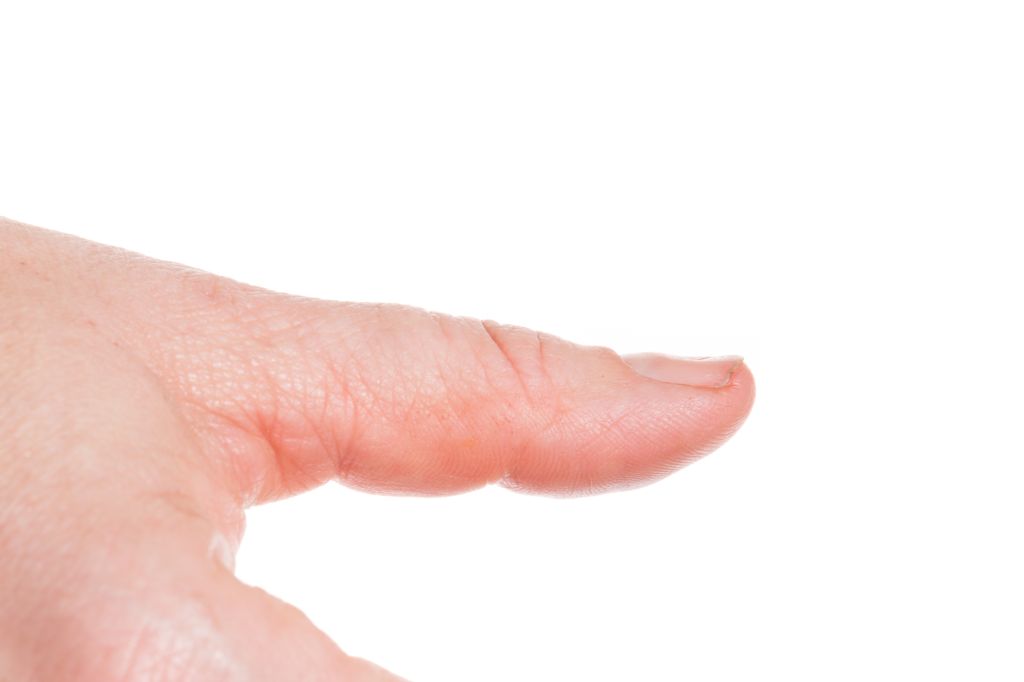 Spoon nail close-up