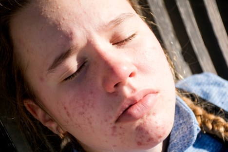 Does Vitamin D Help with Acne?