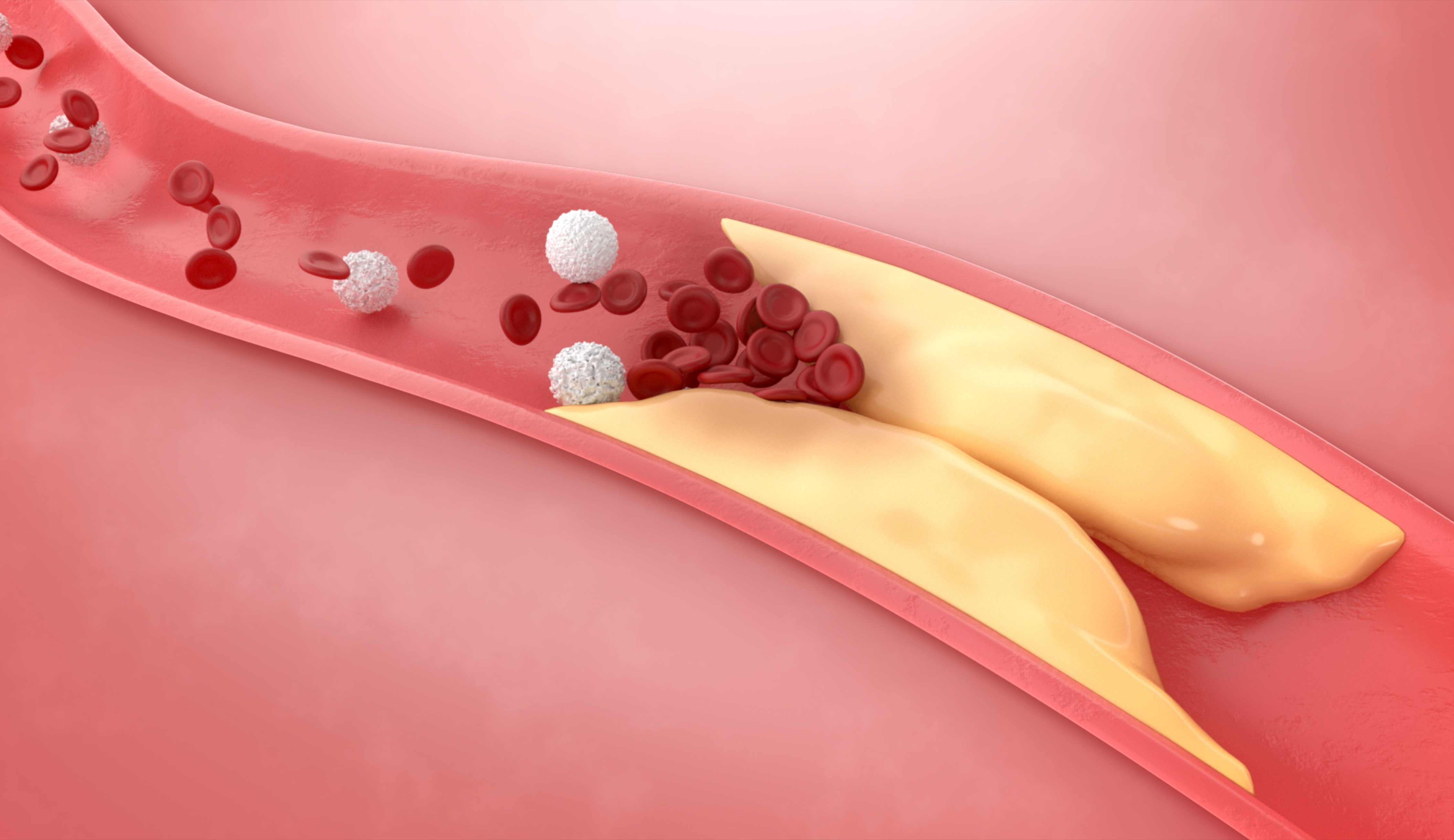 Thickened arteries illustration