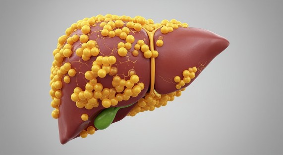 Remove Liver Fat Naturally - Tips and Remedies