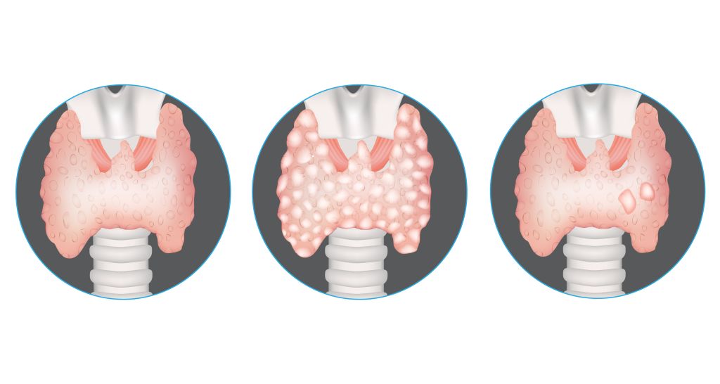 Thyroid nodules   