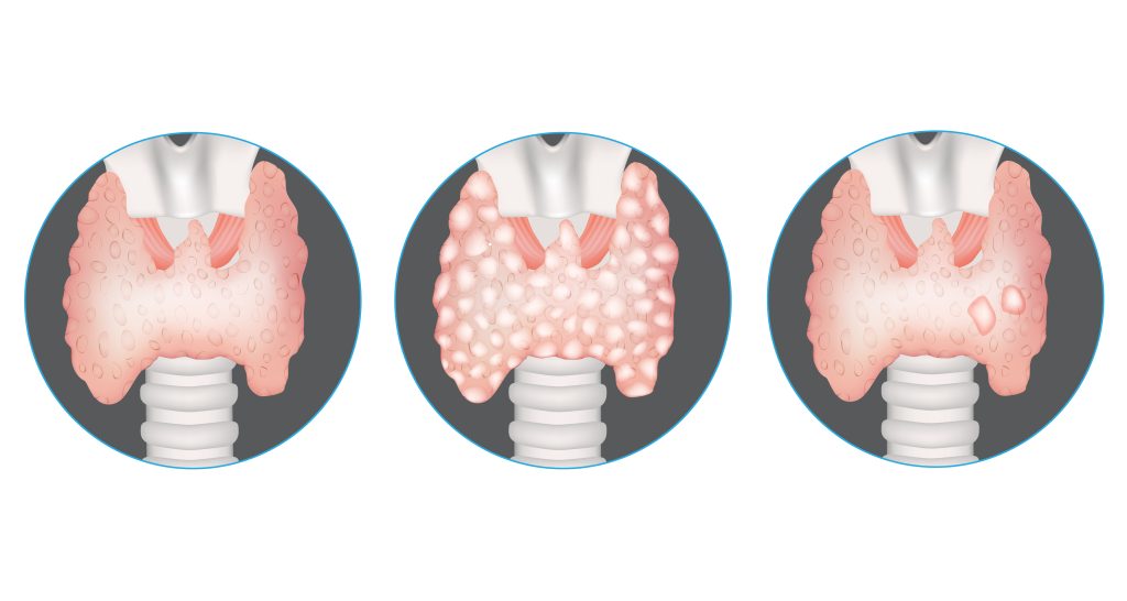 Thyroid nodules   