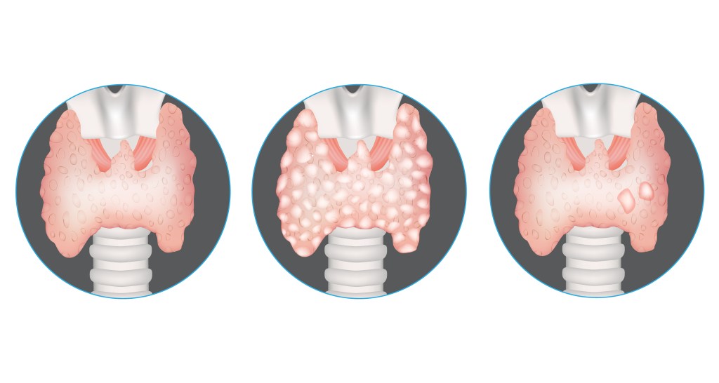 Thyroid nodules   