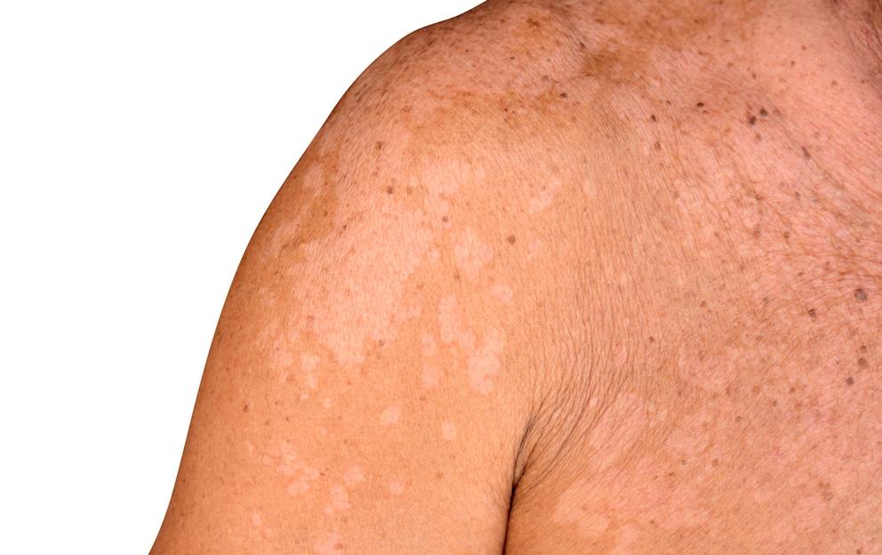 Dark Spots on Skin: Causes and Natural Remedies | Dr. Berg