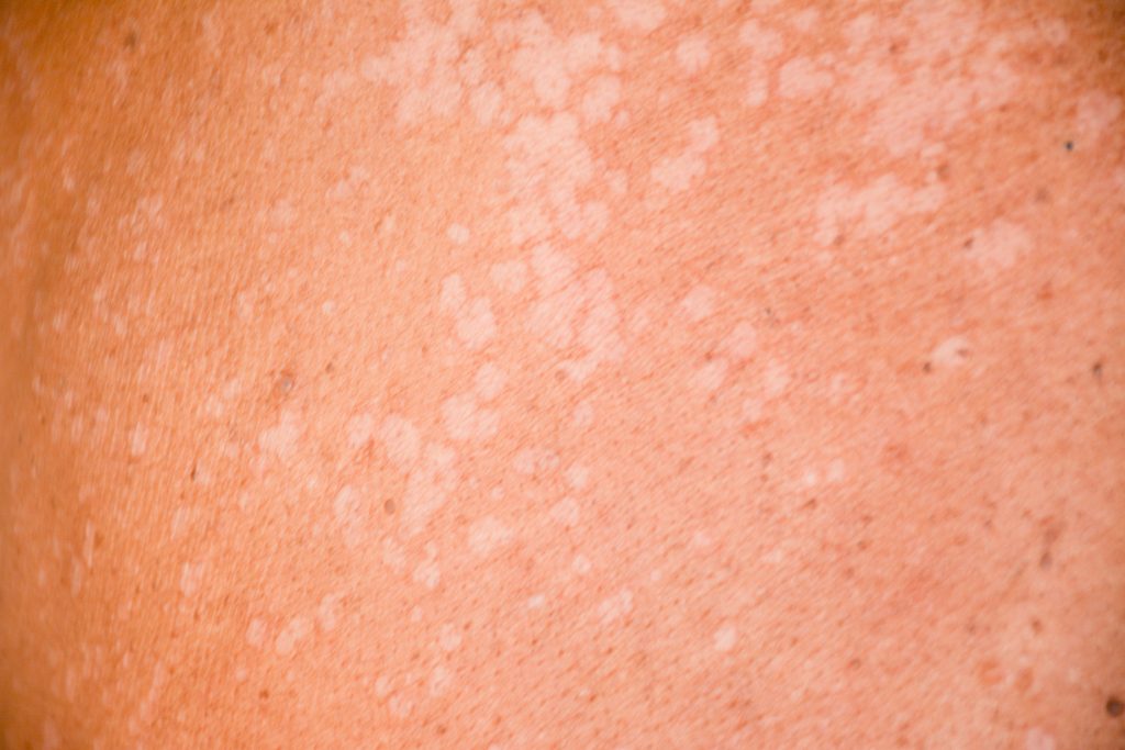 Tinea versicolor on skin
