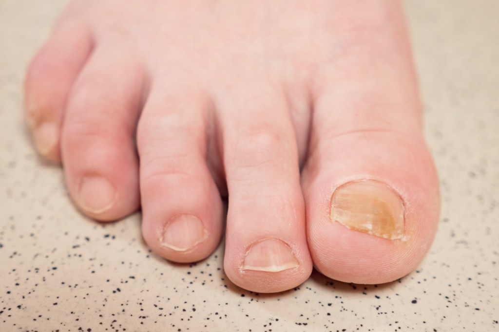 Yellowing toenail from fungal infection