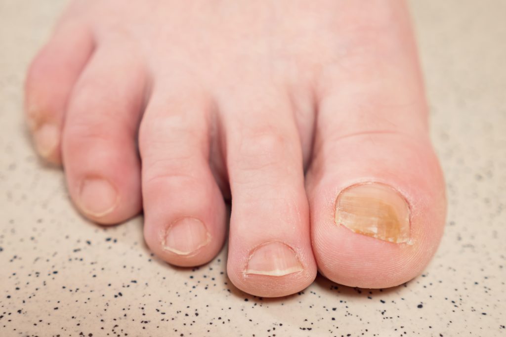 Yellowing toenail from fungal infection