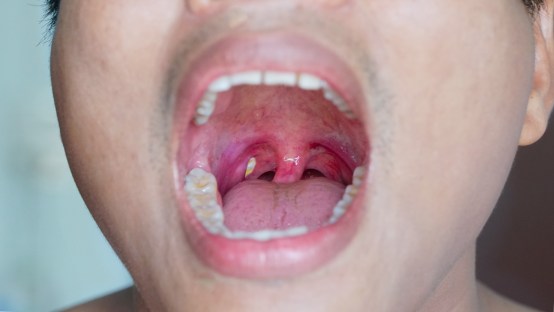 How to Help Prevent Tonsil Stones: Tips for a Healthy Mouth