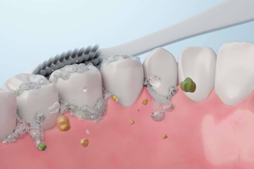 Food particles between teeth 