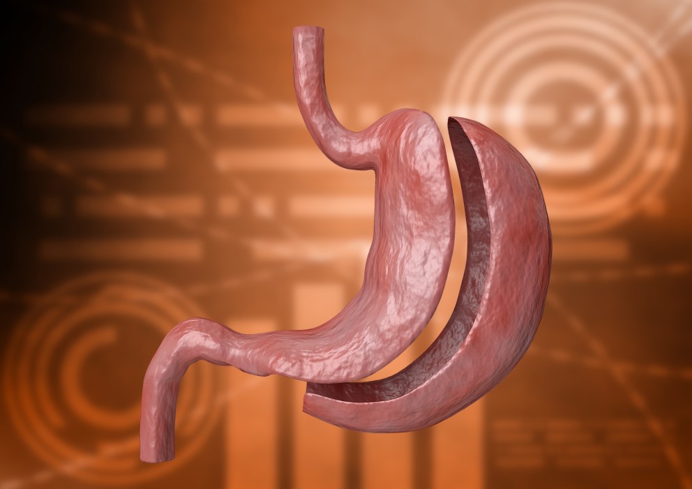 Can I Do Intermittent Fasting after Gastric Sleeve Surgery?