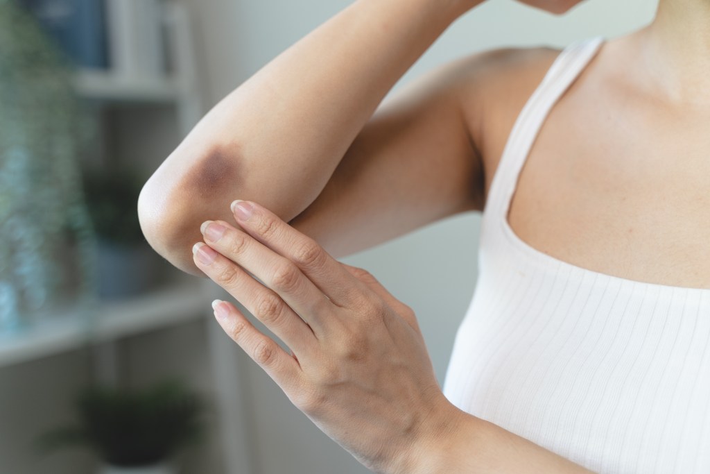 Woman with a bruise
