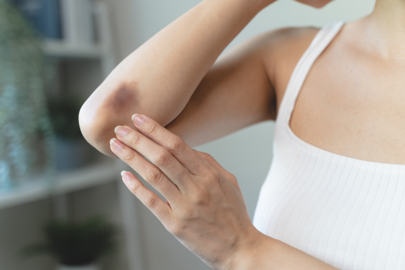 Woman with a bruise