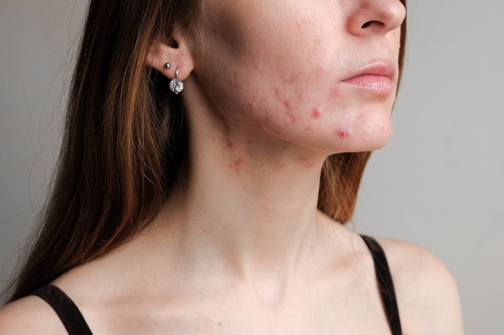 Hormonal Acne: Diet Tips, Causes, and Remedies