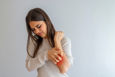 What Is Eczema? Symptoms and Causes of Eczema