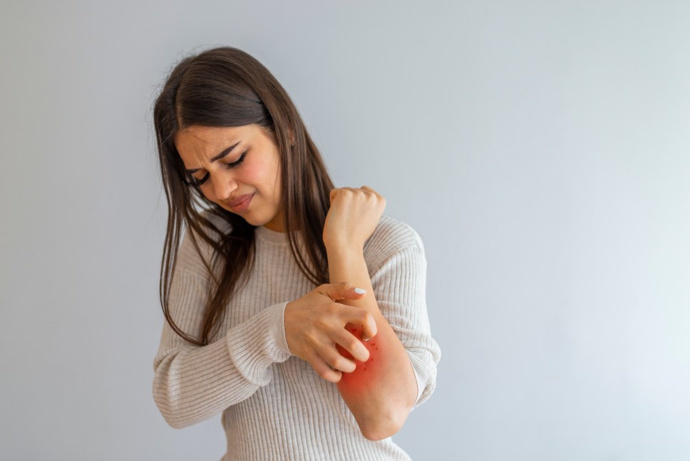 What Is Eczema? Symptoms and Causes of Eczema
