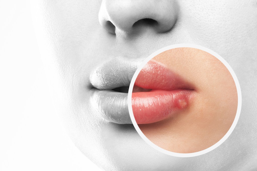 Herpes virus
