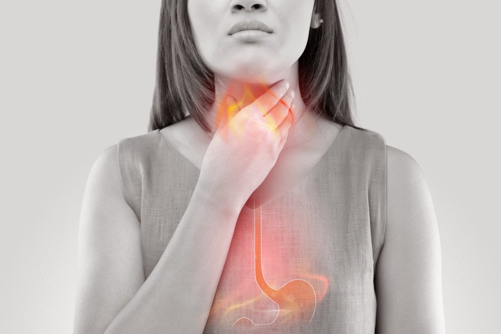Acid reflux illustration