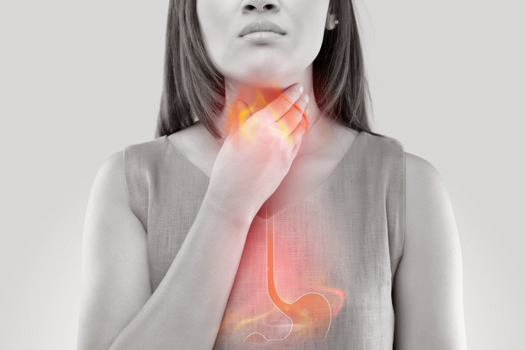 Acid reflux illustration