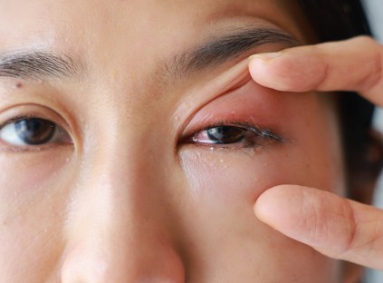 What Causes Inflamed Eyelids?