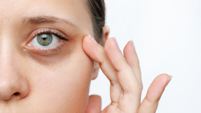 Girl with dark eye circles