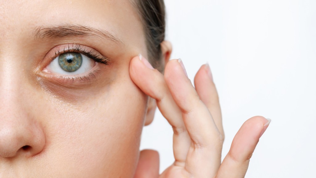 Girl with dark eye circles