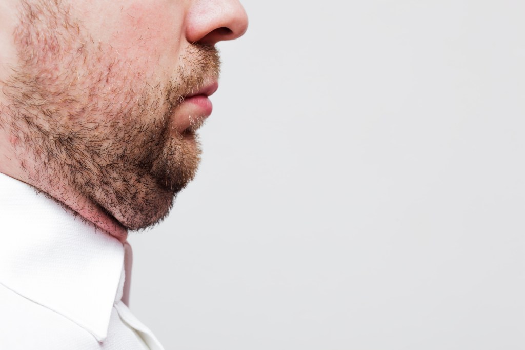 Male double chin