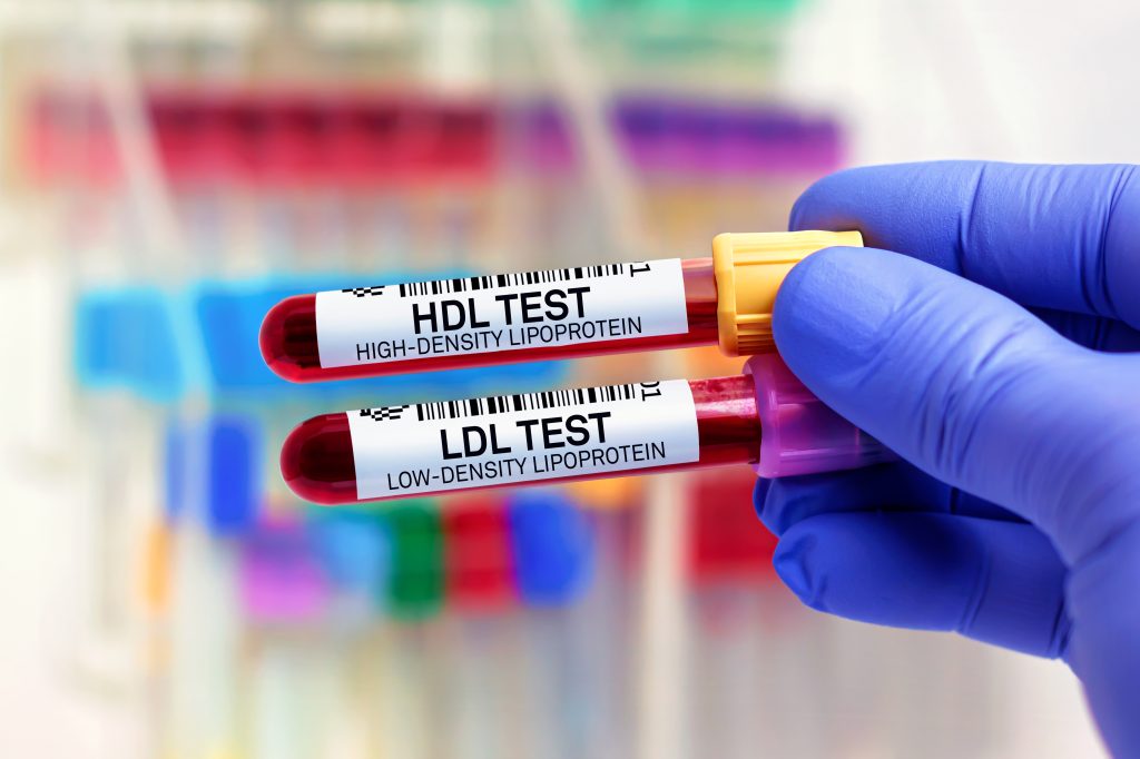 HDL and LDL blood sample