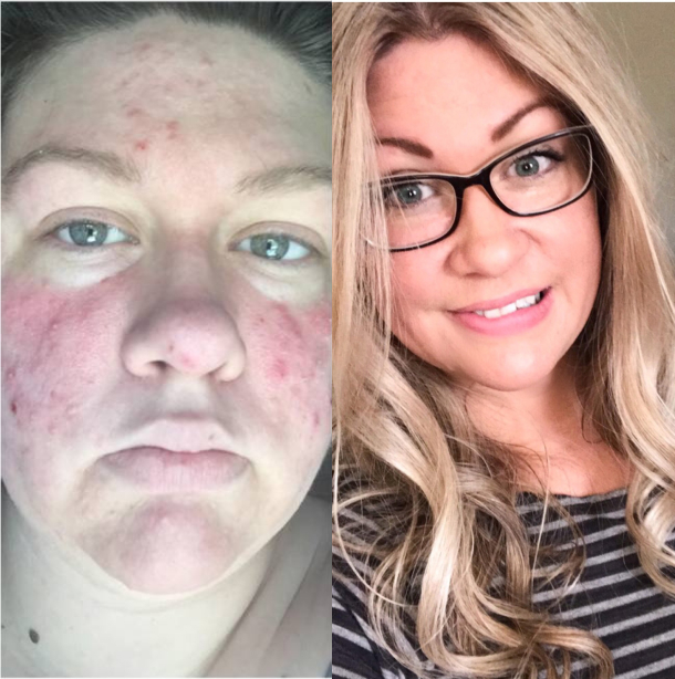 Before and after face image of Carissa Kelly