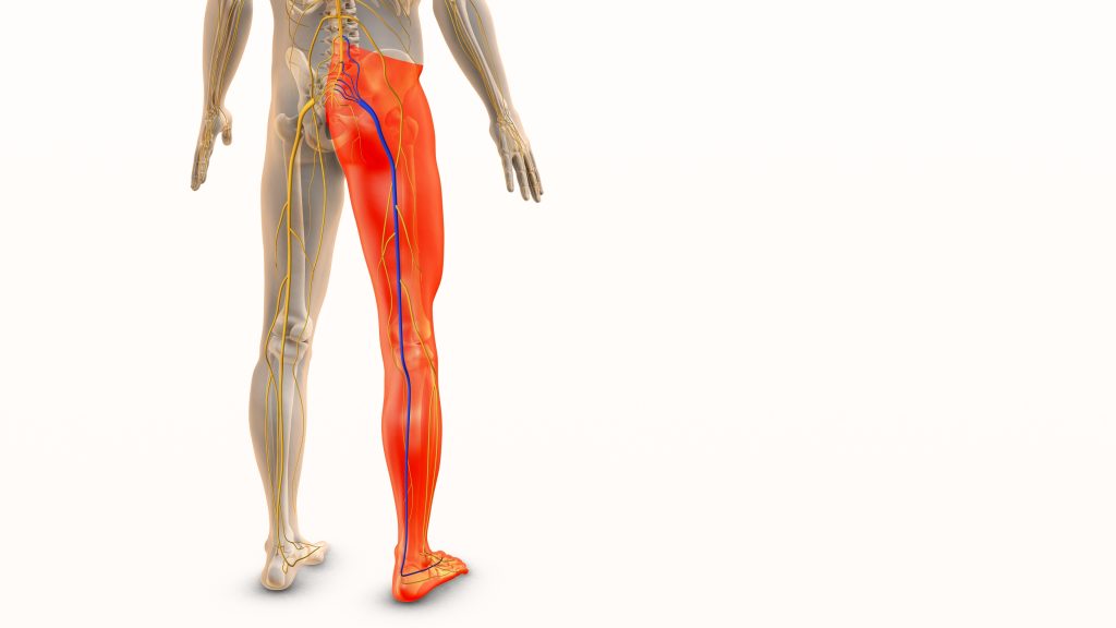Sciatica concept  