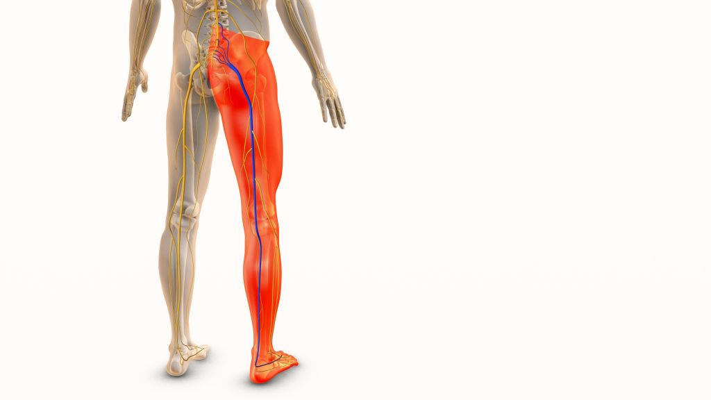 Sciatica concept