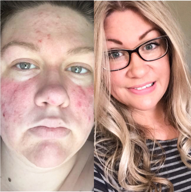 Before and after face image of Carissa Kelly